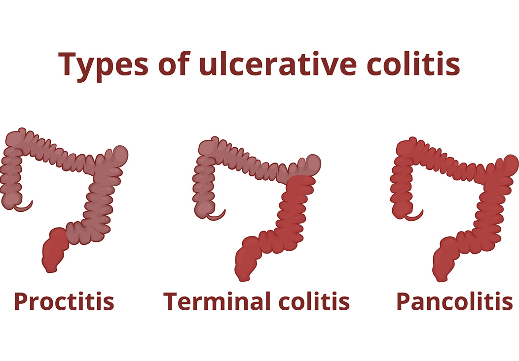 Ulcerative Colitis Symptoms And Causes Spark Health California 6898