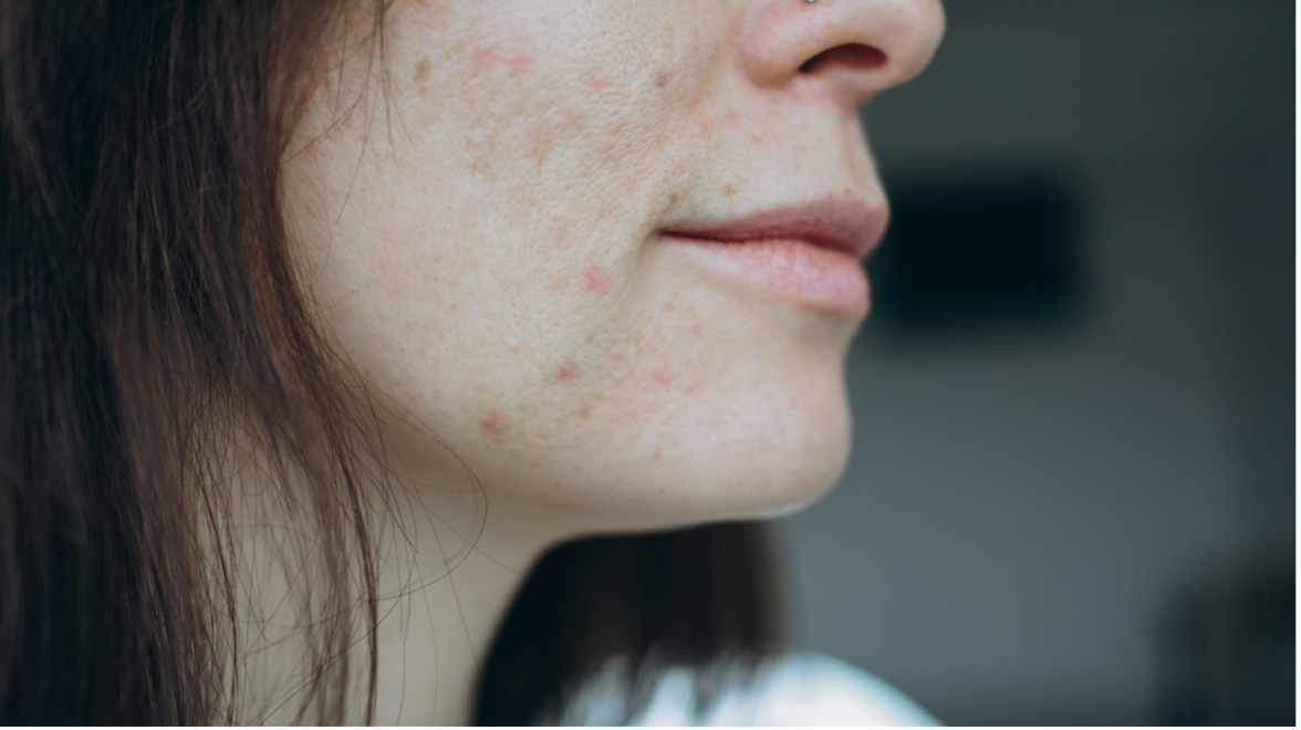 Acne Over 30? It’s More Than Just Hormones